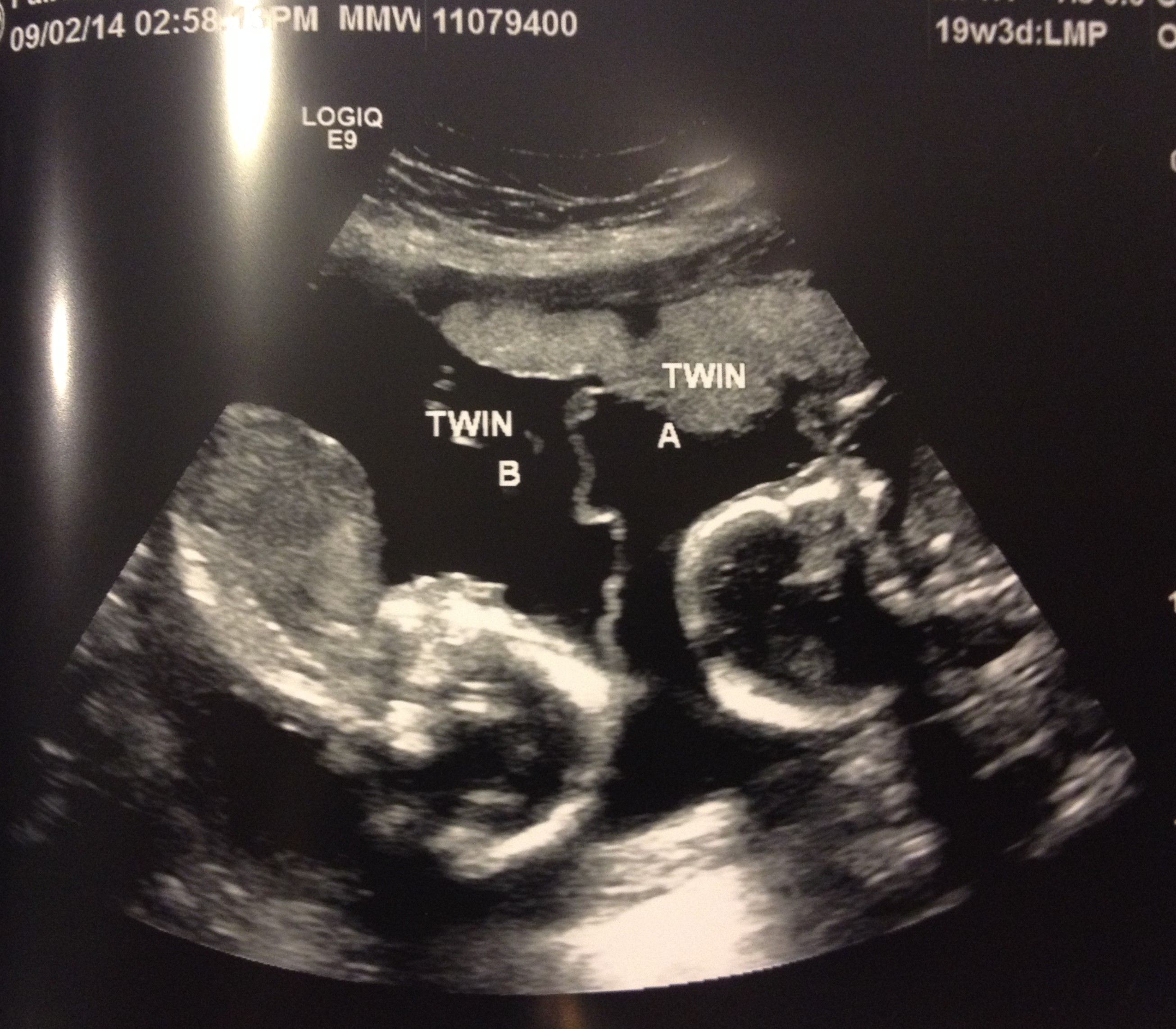 Роды 15 недель. УЗИ 15 недель беременности двойня. Плод 14 недель беременности двойня.